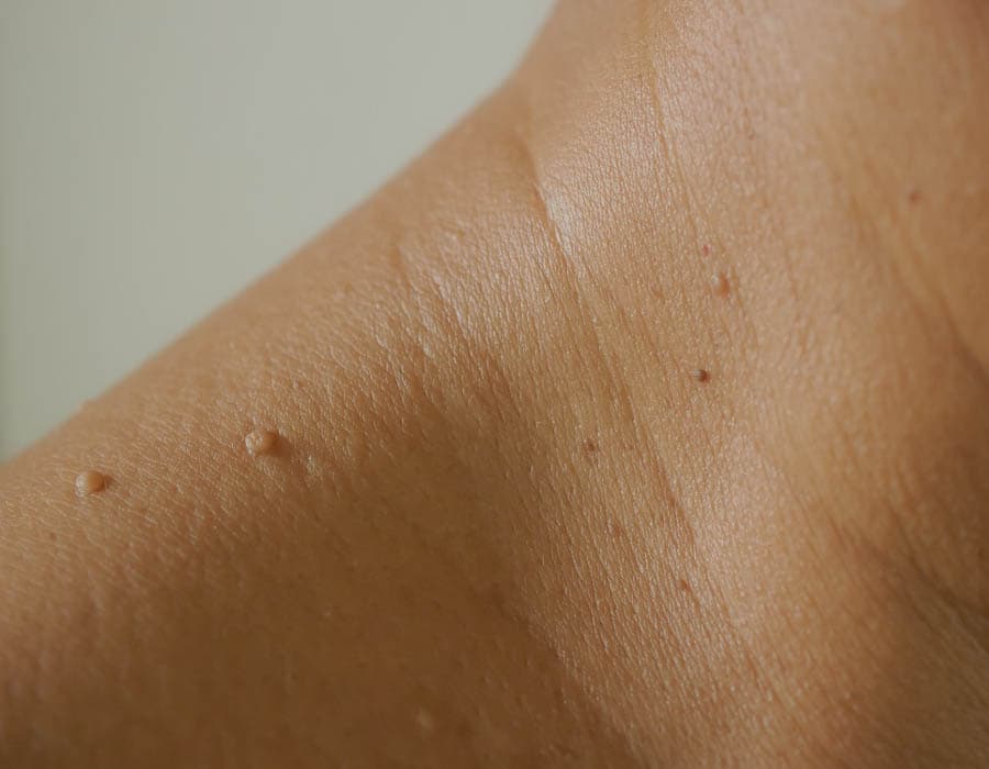 Mole & Skin Tag Removal