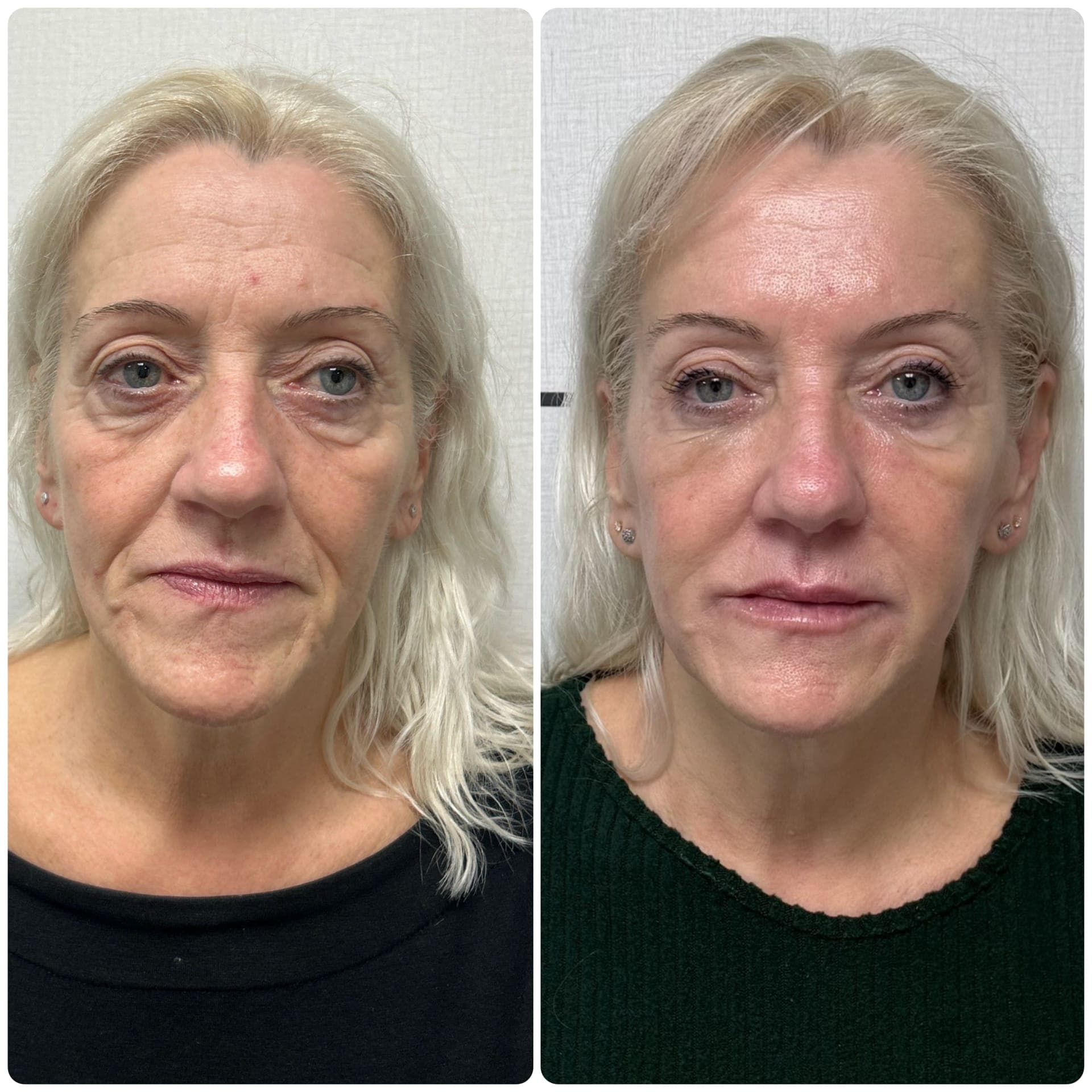 Cover image for Joanne’s 10 Years Younger Journey In Yorkshire