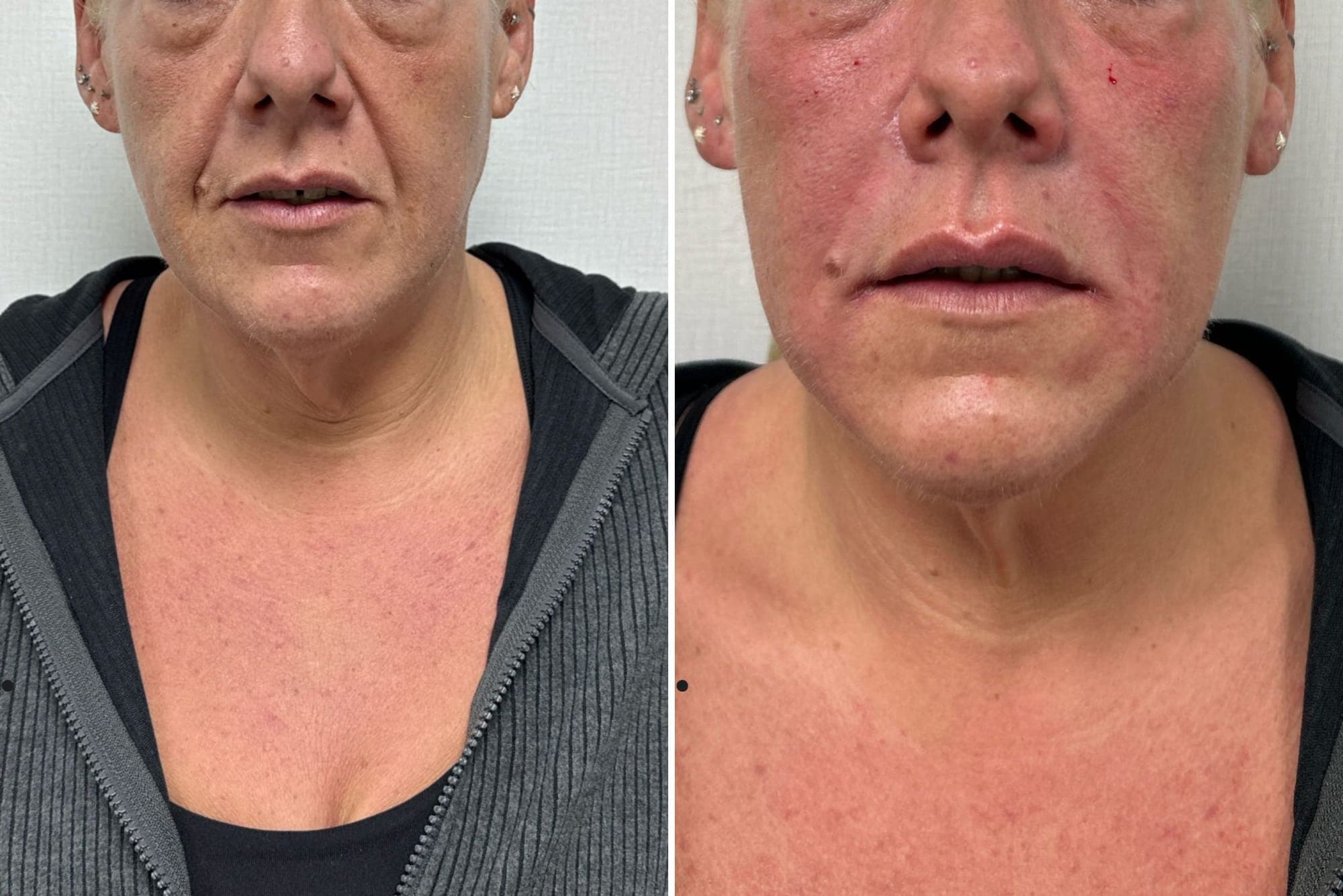 Cover image for Marionette Line Treatment Using Dermal Fillers in South Yorkshire (1)