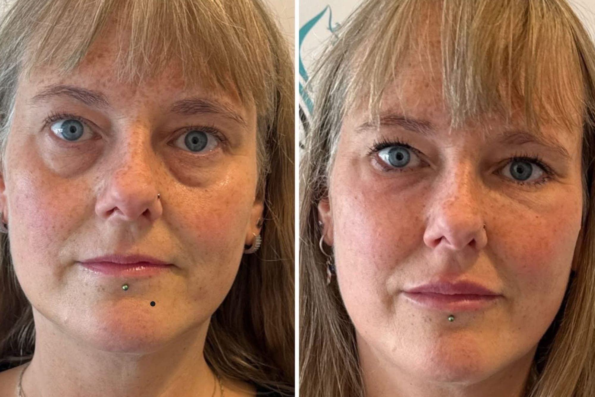 Cover image for Under Eye Filler Treatment in South Yorkshire